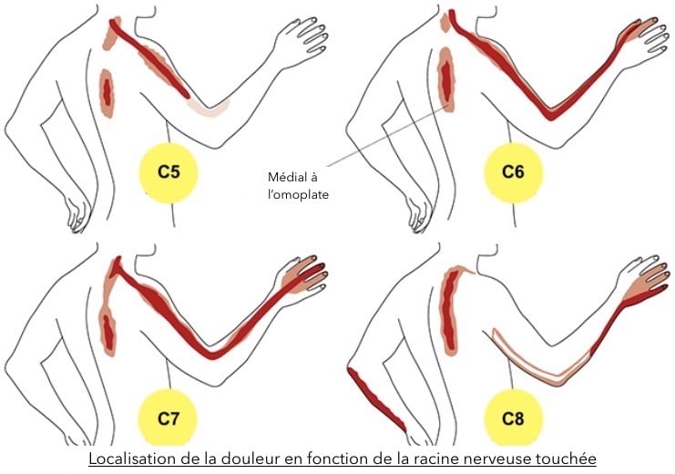 la fibromyalgie