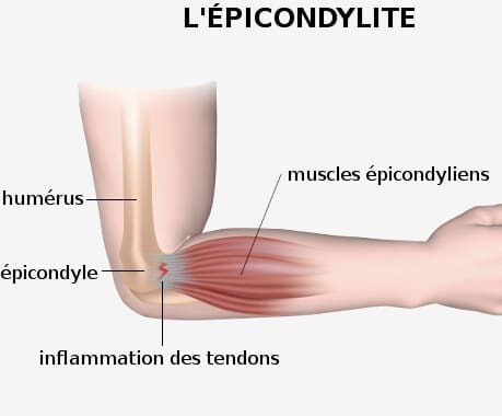 Tendinite du coude : les causes
